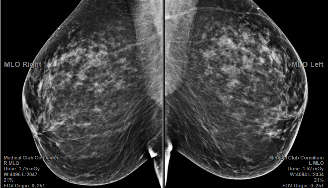 Обработка и визуализация для маммографии