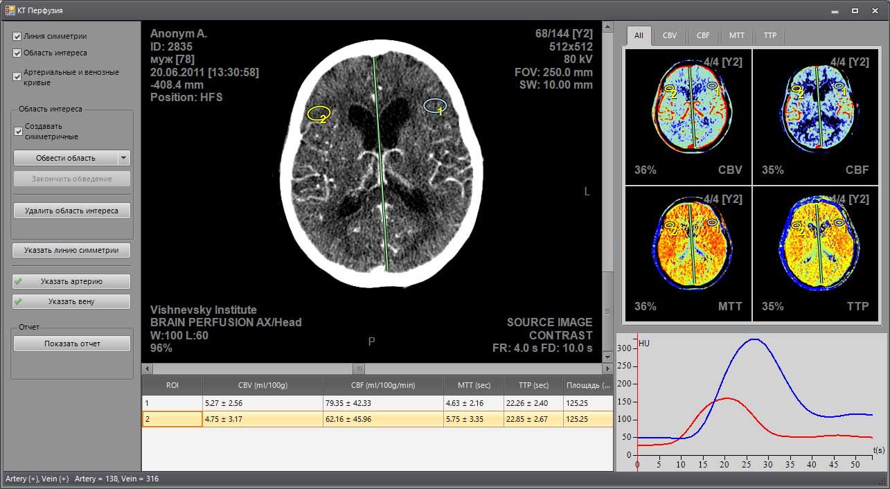 Перфузия головного мозга по КТ