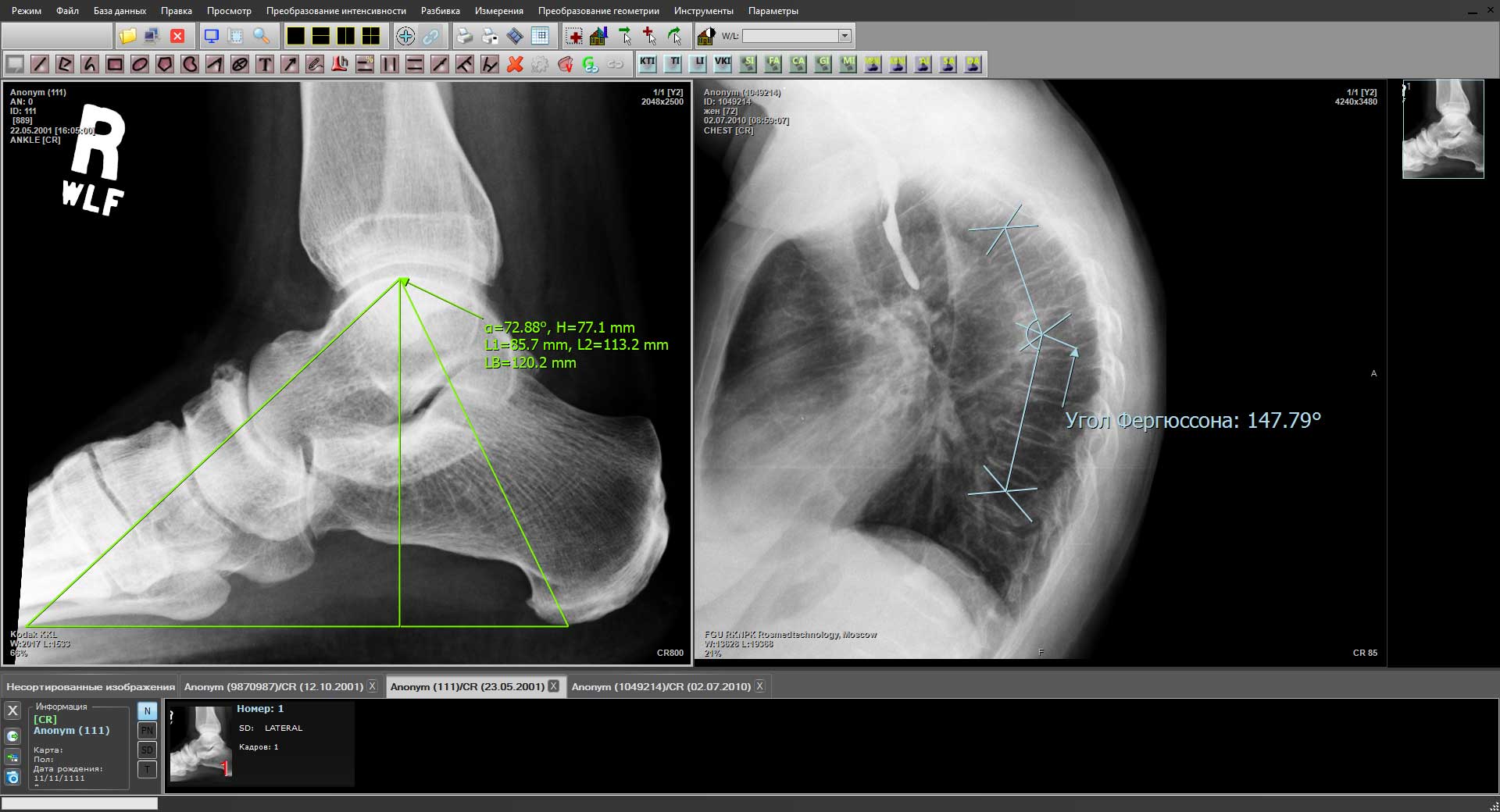Измерения при обработке рентгеновских изображений